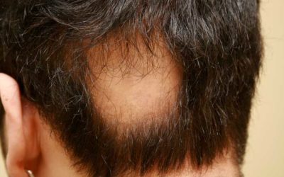 Alopecie areata | Zkušenosti a léčba + VIDEO