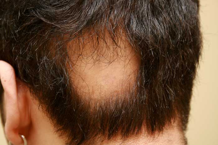 alopecie areata