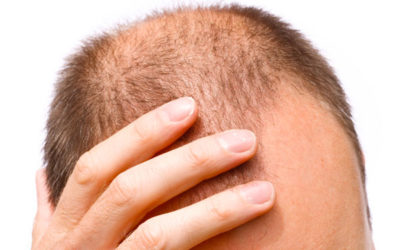 Androgenní alopecie a Dihydrotestosteron (DHT)