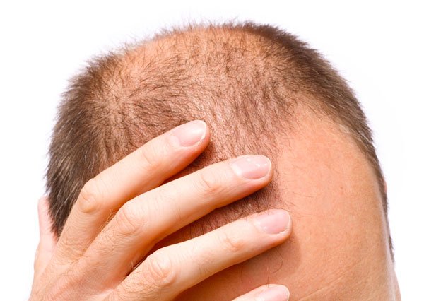 androgenní alopecie