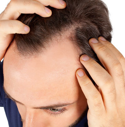 padání vlasů příčiny a léčba