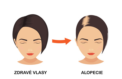 zdravé vlasy vs alopecie