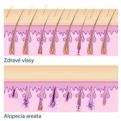 zdravé vlasy vs alopecie areata